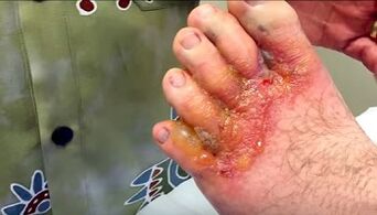 ayak parmaklarında mantar belirtileri
