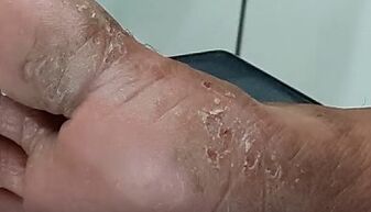 ayak parmaklarında mantar türleri ve formları