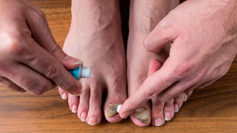 Onikomikozu tedavi etmek için ayak tırnaklarına antifungal krem ​​uygulamak